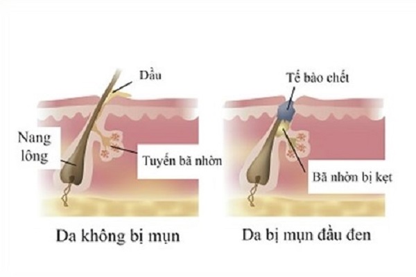 nguyên nhân gây mụn đầu đen